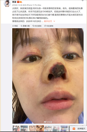 高溜 ガオ・リュー 軟骨 鼻 整形 手術 失敗 壊死 中国 女優 微博