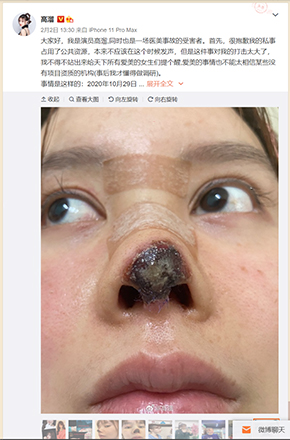 高溜 ガオ・リュー 軟骨 鼻 整形 手術 失敗 壊死 中国 女優 微博