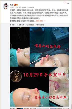 高溜 ガオ・リュー 軟骨 鼻 整形 手術 失敗 壊死 中国 女優 微博