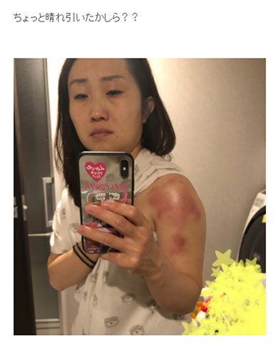 キンタロー。 ビタミンD 炎症 アレルギー 注射