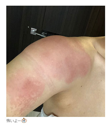 キンタロー。 ビタミンD 炎症 アレルギー 注射