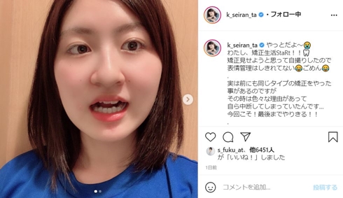 小林星蘭 子役 現在 歯列矯正 インビザライン