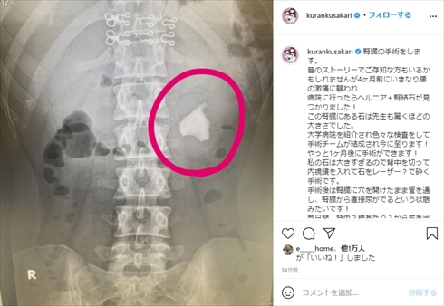 紅蘭 手術 腎結石 ヘルニア インスタ 草刈正雄
