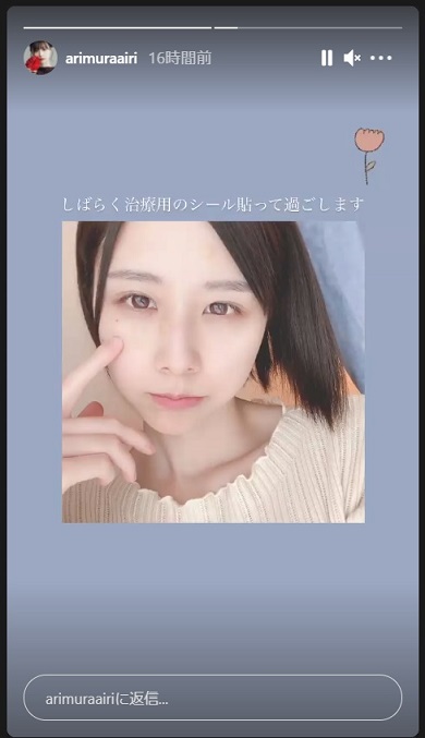 有村藍里 ホクロ 除去 稗粒腫