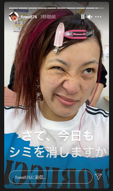 フワちゃん シミ レーザー治療