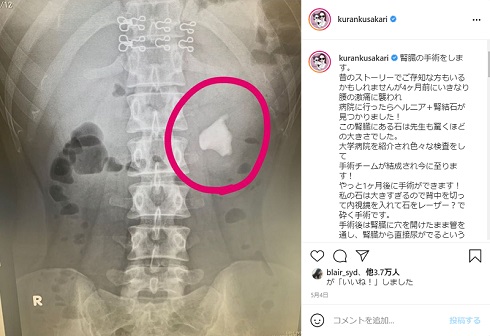 紅蘭 腎結石 退院 手術