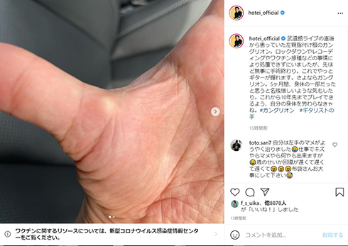 布袋寅泰 手術 腫瘤 ガングリオン