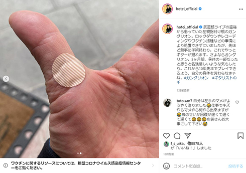 布袋寅泰 手術 腫瘤 ガングリオン