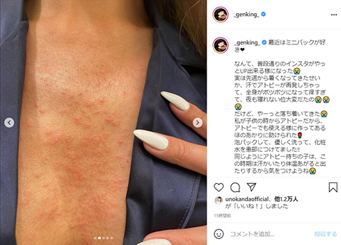 GENKING アトピー 発疹 湿疹