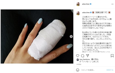 足立梨花 中指 ケガ 包帯 手術