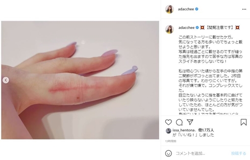 足立梨花 中指 ケガ 包帯 手術