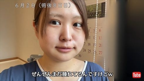 伊藤かりん 乃木坂46 顎変形症 下顎前突 手術 術後 矯正 YouTube