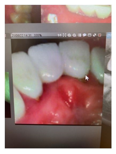 アレン ジルコニアクラウン 歯 折れた 治療 割れた