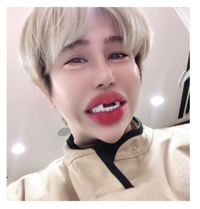 アレン ジルコニアクラウン 歯 折れた 治療 割れた