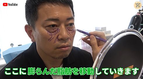 宮迫博之 雨上がり決死隊 クマ ほうれい線 美容整形手術