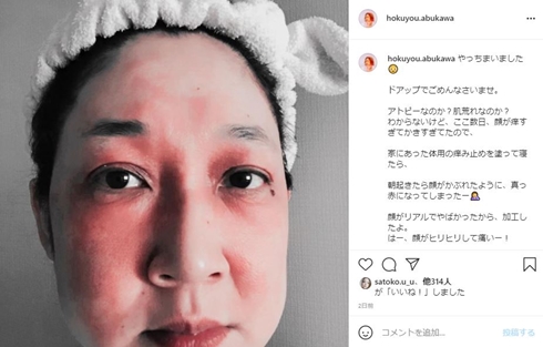 虻川美穂子 アトピー 肌荒れ ヒリヒリ 顔