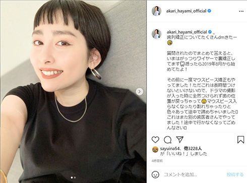 早見あかり ももいろクローバーZ 歯列矯正