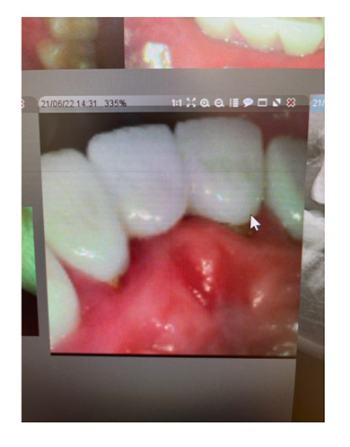 アレン 整形男子 差し歯