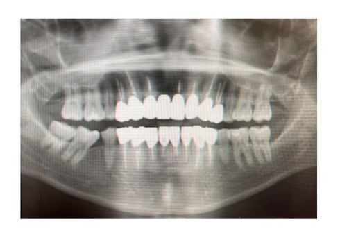 アレン 整形男子 差し歯