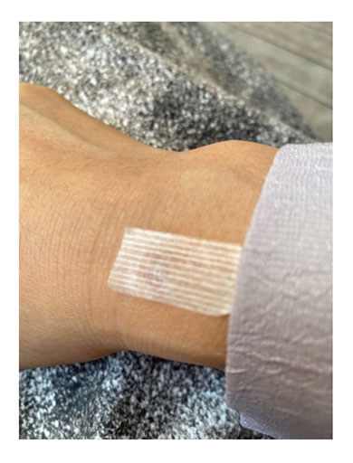 堀ちえみ 口腔がん 良性腫瘍 食道がん