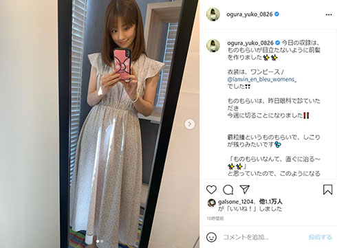 小倉優子 ものもらい 手術