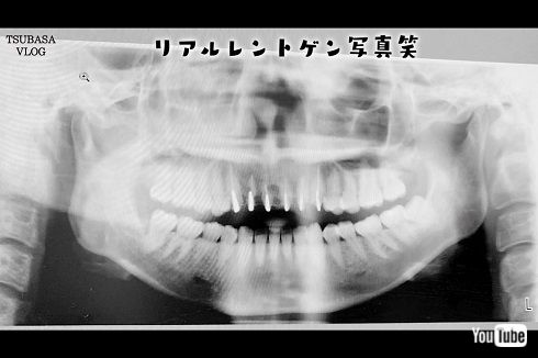 益若つばさ 整形 告白 美容