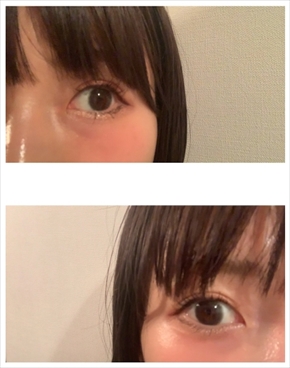 桃あいのり ブログ プチ整形 埋没手術 二重 一重 再手術