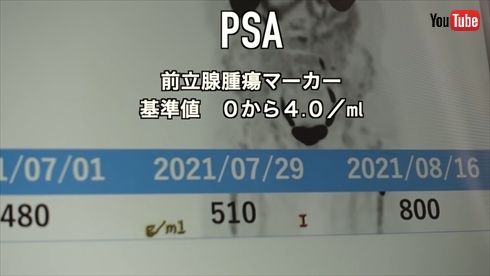 西郷輝彦 前立腺がん ステージ4 オーストラリア YouTube PSMA治療