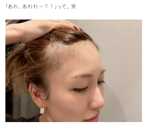 桃 あいのり 産後 抜け毛 ハゲ