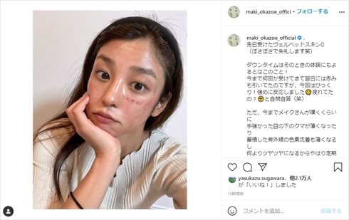 岡副麻希 美肌治療 ダウンタイム ヴェルベットスキン 肌 インスタ