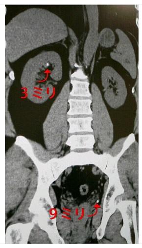 サンドウィッチマン 富澤たけし 尿路結石