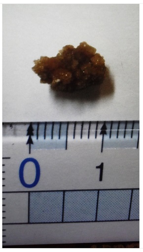 サンドウィッチマン 富澤たけし 尿路結石