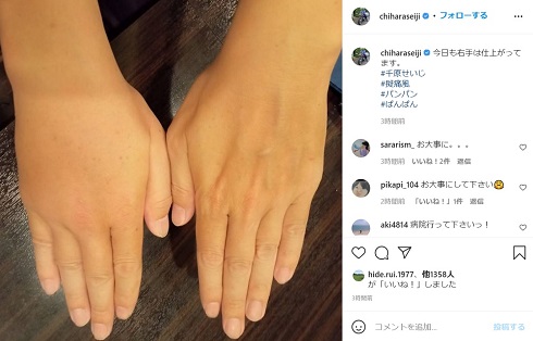 千原せいじ 偽痛風 手 腫れ