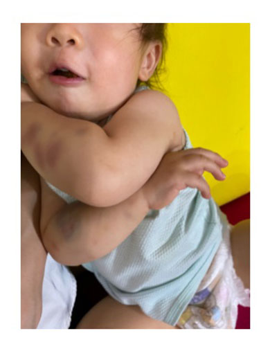 はんにゃ 川島章良 難病 特発性血小板減少性紫斑病