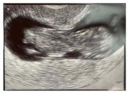 だいたひかる 妊娠 後期 高齢 出産 偏見 ホルモン バランス マタニティライフ