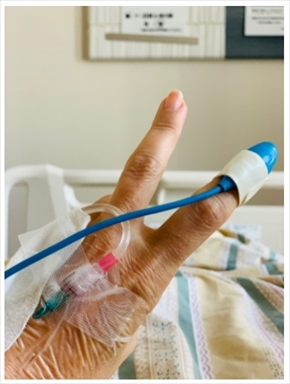 LiLiCo 左膝蓋骨 骨折 ボルト ワイヤー 抜去手術 ブログ