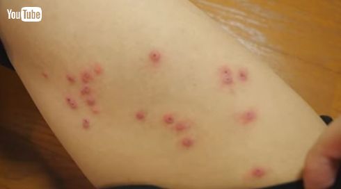 はじめしゃちょー 高熱 ダニ 感染症 PCR検査