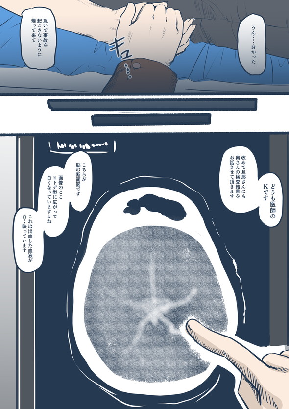 クモ膜下出血 入院 手術 救急車 集中治療室.