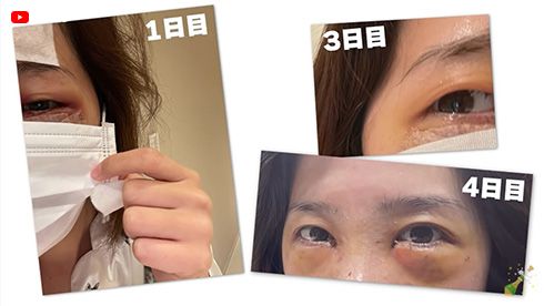 エンリケ キャバ嬢 美容整形 クマ