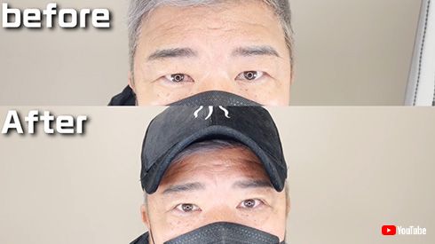 亀田史郎 美容整形 二重埋没法