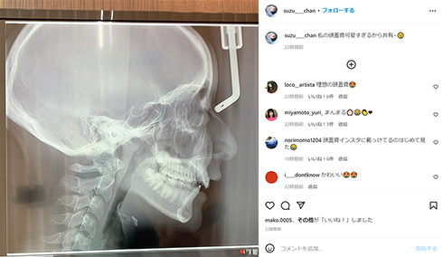 山之内すずさんの頭蓋骨
