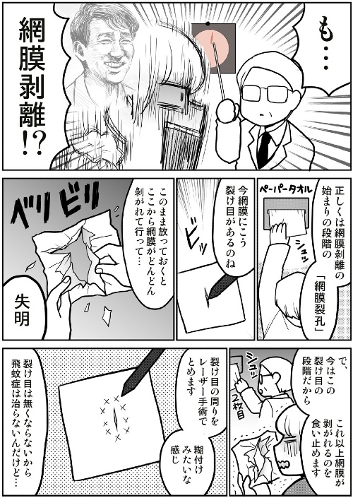 飛蚊症から網膜剥離