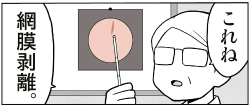 飛蚊症から網膜剥離