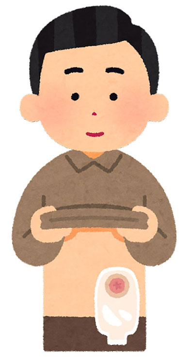 ストーマ用装具を付けた人