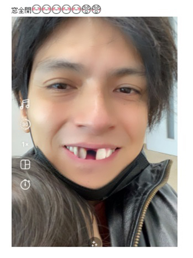 前歯が抜けたアレクサンダー