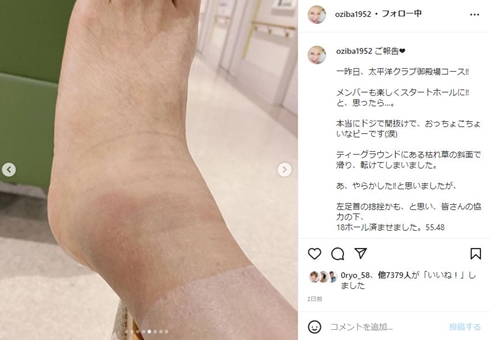 足を骨折したピーターこと池畑慎之介