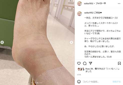 腫れ上がった左足首