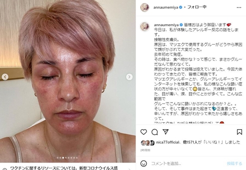 接触性皮膚炎で顔が腫れ上がった梅宮アンナ