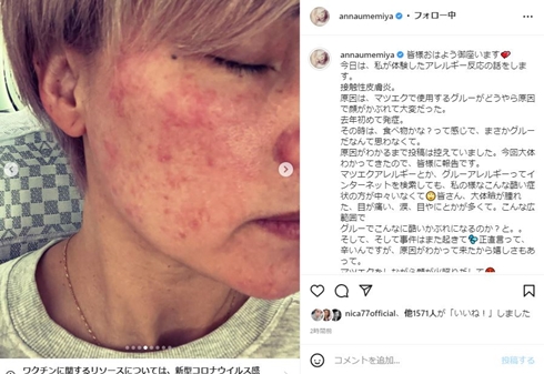梅宮アンナ アレルギー まつエク グルー 接触性皮膚炎