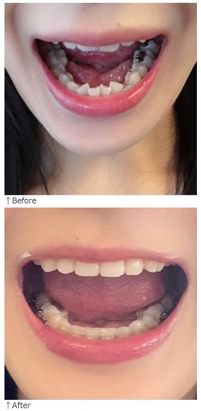 歯列矯正をした八田亜矢子